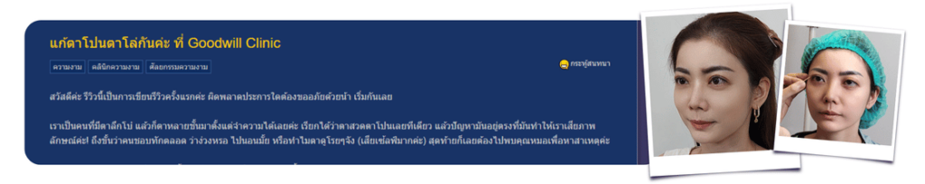 รีวิวตา2ชั้น goodwill clinic pantip แก้ไขตาสองชั้น แก้ไขตาโปน ตาหลายชั้น