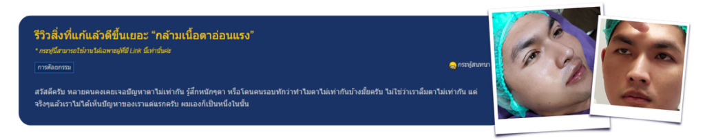 รีวิวตา2ชั้น แก้กล้ามเนื้อตาอ่อนแรง เคสผู้ชาย แก้ตาไม่เท่ากัน