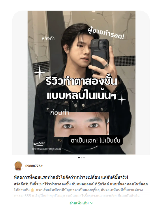 รีวิวตา2ชั้นครั้งแรก แก้ตาสองชั้นเป็นแฉก ชั้นตาหลบในธรรมชาติ