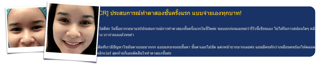 รีวิวตาสองชั้น goodwill clinic pantip กรีดยาวพร้อมย้ายไขมัน