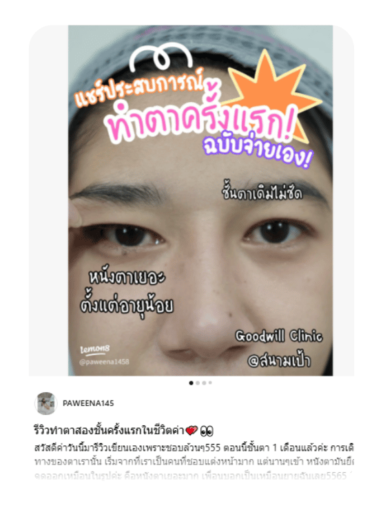 รีวิวตาสองชั้น น้องแป้ง goodwill clinic