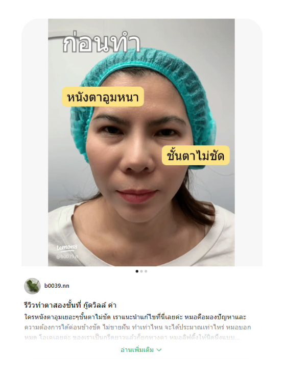 รีวิวตาสองชั้น แก้หนังตาอูม