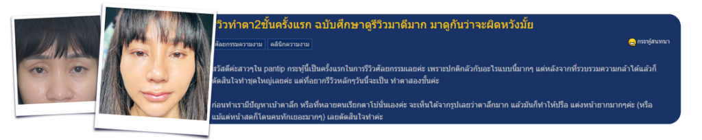 รีวิวทำตา2ชั้น ครั้งแรก goodwill clinic