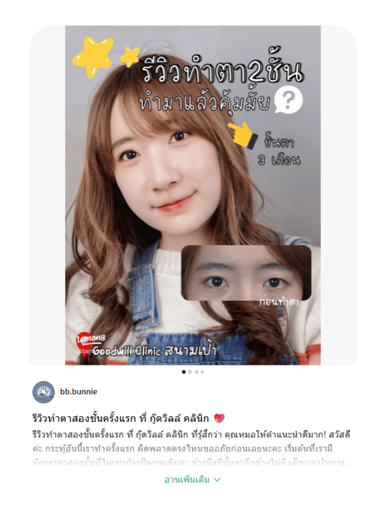 รีวิวทำตาสองชั้น คุณแนน