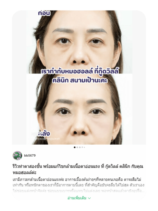 รีวิวทำตาสองชั้นพร้อมแก้ไขกล้ามเนื้อตาอ่อนแรง กับหมอฮอลล์ ที่กู๊ดวิลล์ คลินิก
