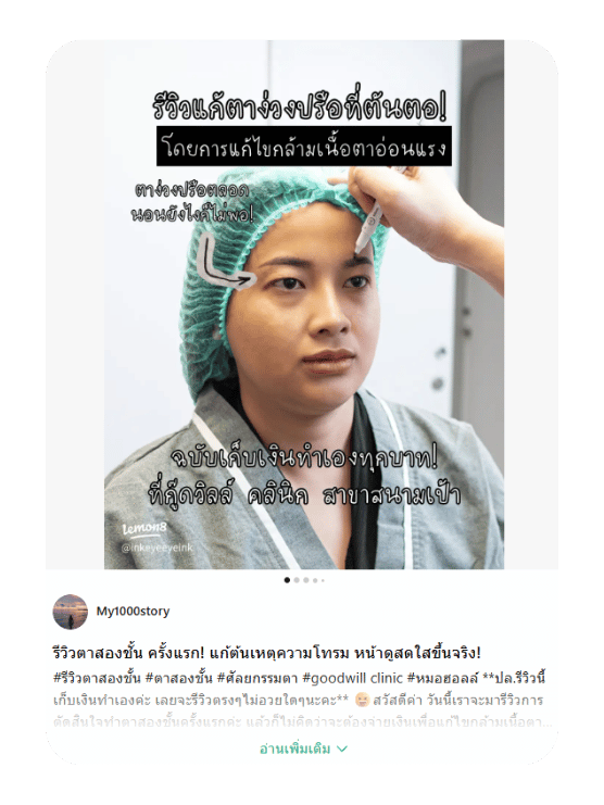 รีวิวแก้ตาง่วง หน้าโทรมที่ต้นตอ พร้อมแก้กล้ามเนื้อตา