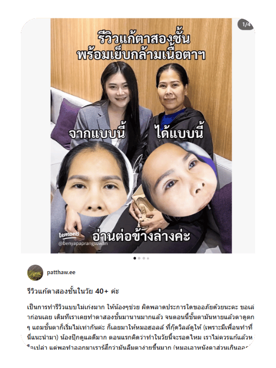 รีวิวแก้ตาสองชั้นในวัย 40+ ค่ะ
