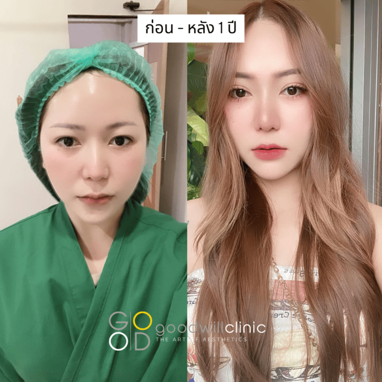 ชั้นตาสายฝอ 1 ปี คุณปูเป้