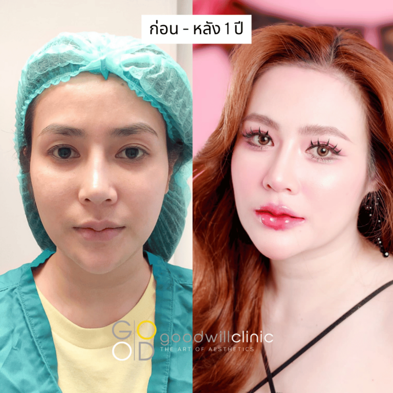 ชั้นตาสายฝอ 1 ปี คุณหญิง