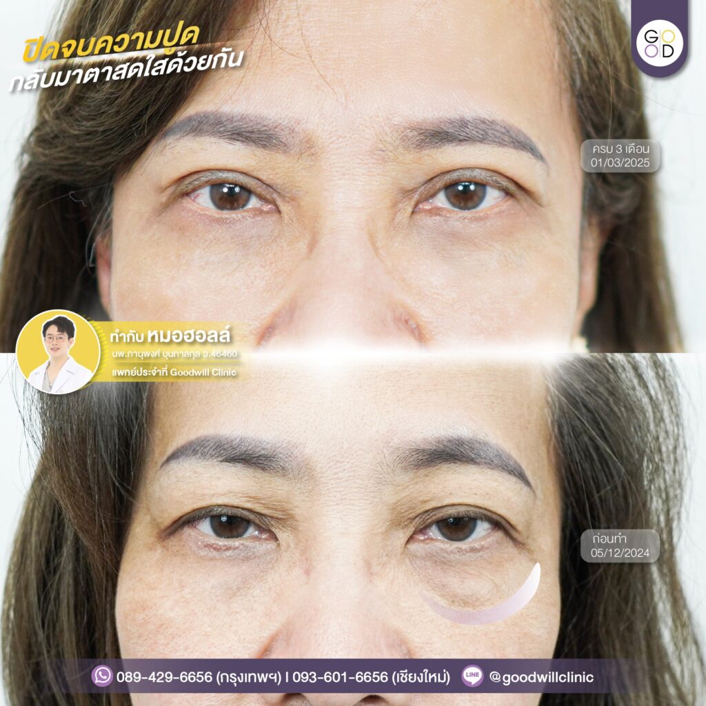 รีวิวผ่าตัดไขมันถุงใต้ตา 5