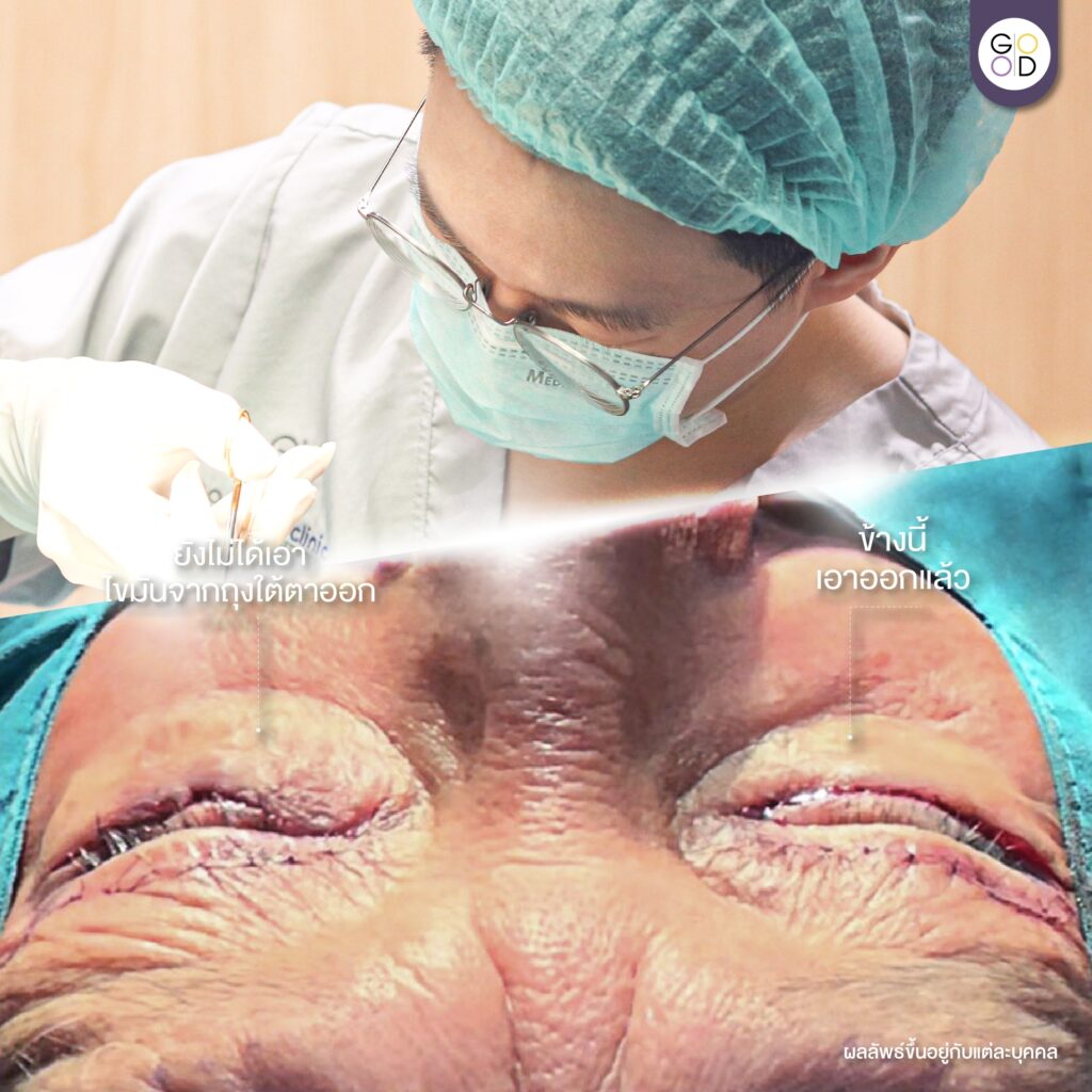 ก่อนหลังผ่าตัดไขมันถุงใต้ตาออกทันที