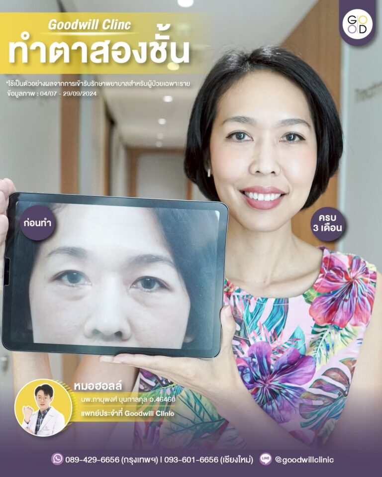 การผ่าตัดไขมันถุงใต้ตา หน้าเด็กลงจริงไหม