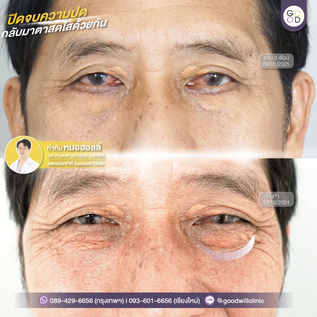 รีวิวผ่าตัดไขมันถุงใต้ตา 2