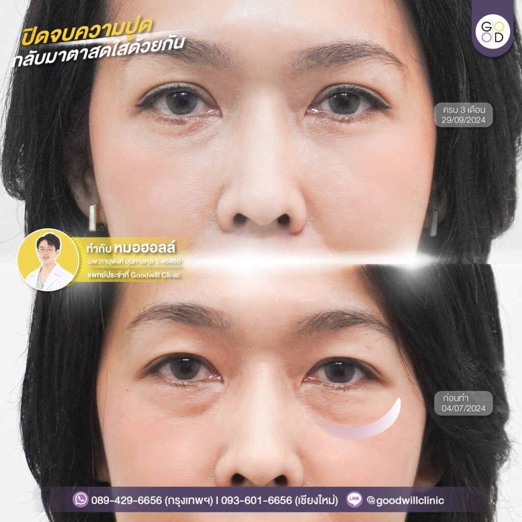รีวิวผ่าตัดไขมันถุงใต้ตา 3
