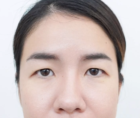 ตัวอย่างคนไข้ตาเศร้า