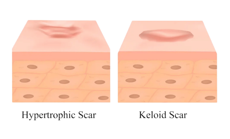 Keloid vs Hypertrophic scar