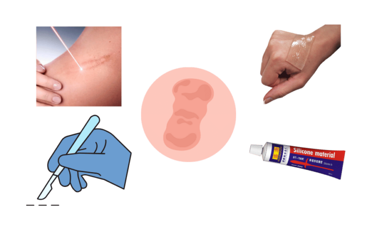 วิธีรักษาคีย์ลอยด์