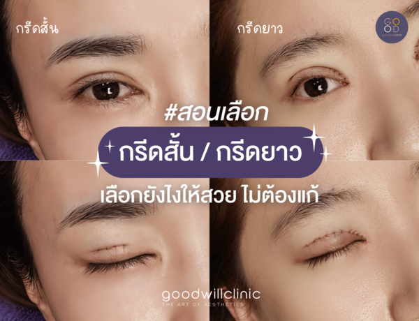 กรีดสั้น vs กรีดยาว ต่างกันยังไง เลือกแบบไหนให้ชั้นตาสวย ไม่ต้องแก้ ปกแก้