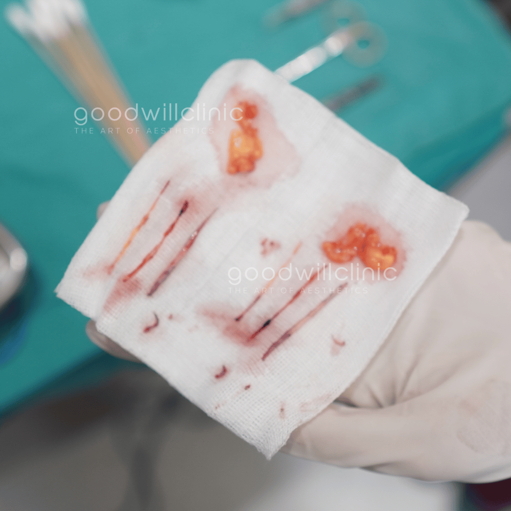 ไขมันเปลือกตา1