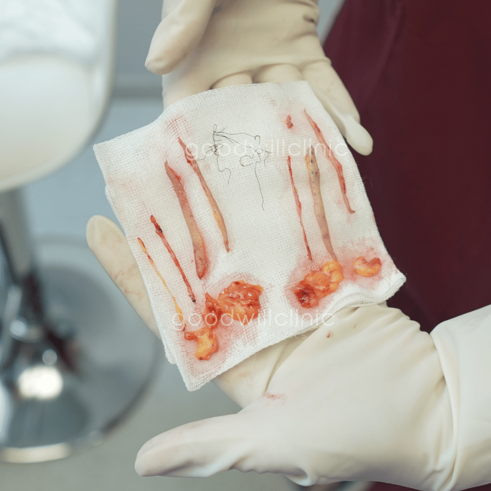 ไขมันเปลือกตา2