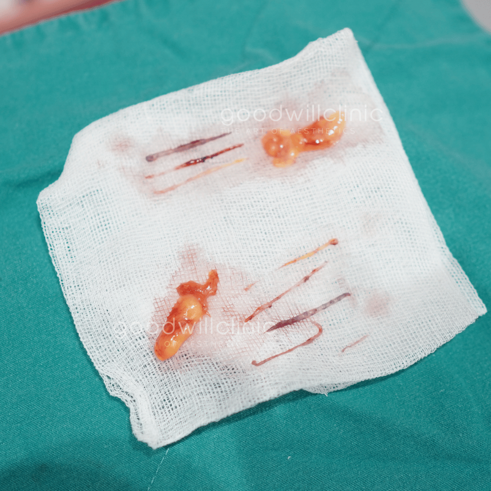 ไขมันเปลือกตา