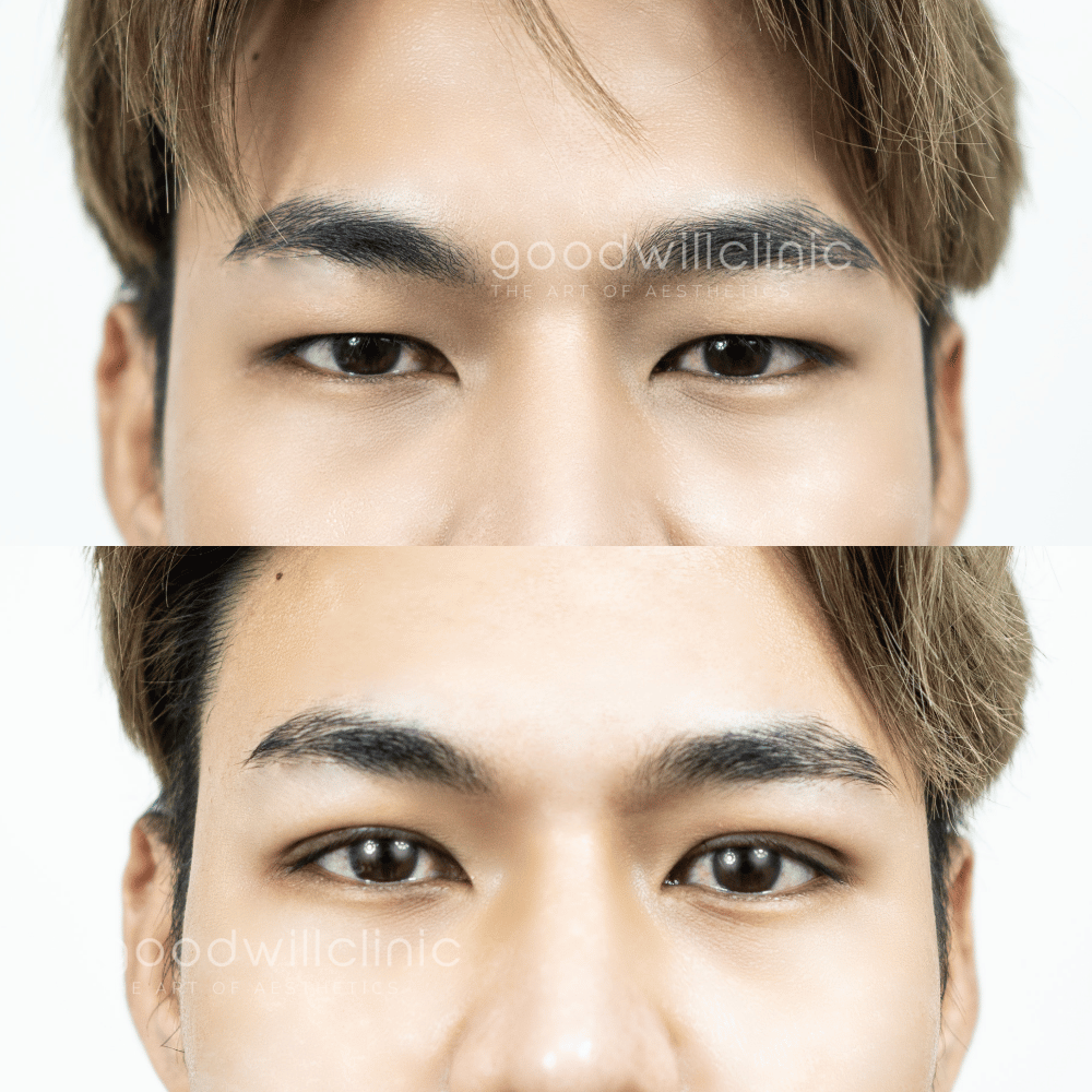 รีวิวไขมันเปลือกตาเยอะ2