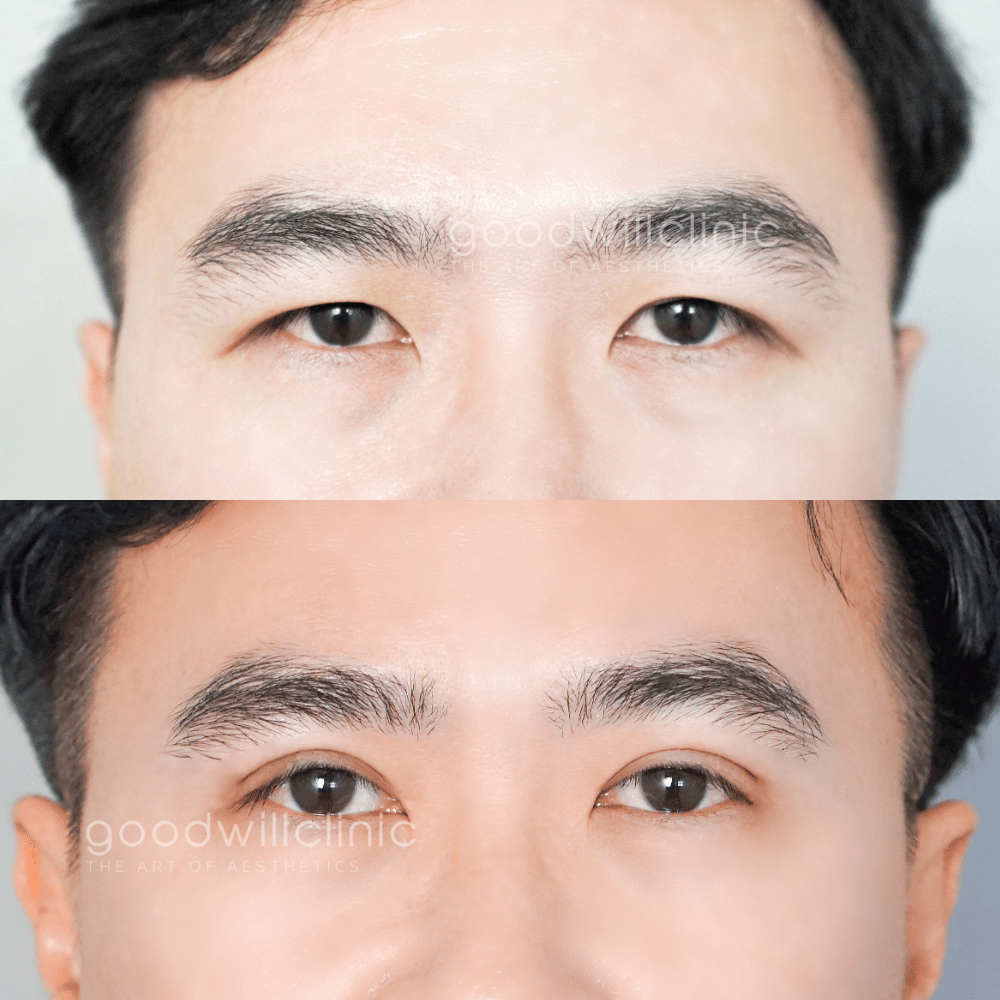 รีวิวไขมันเปลือกตาเยอะ3