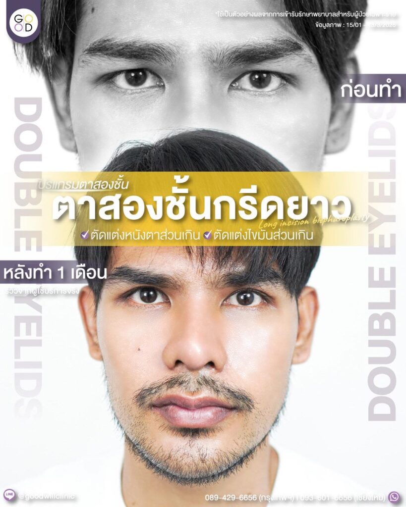 ไขมันตาเยอะผู้ชาย2