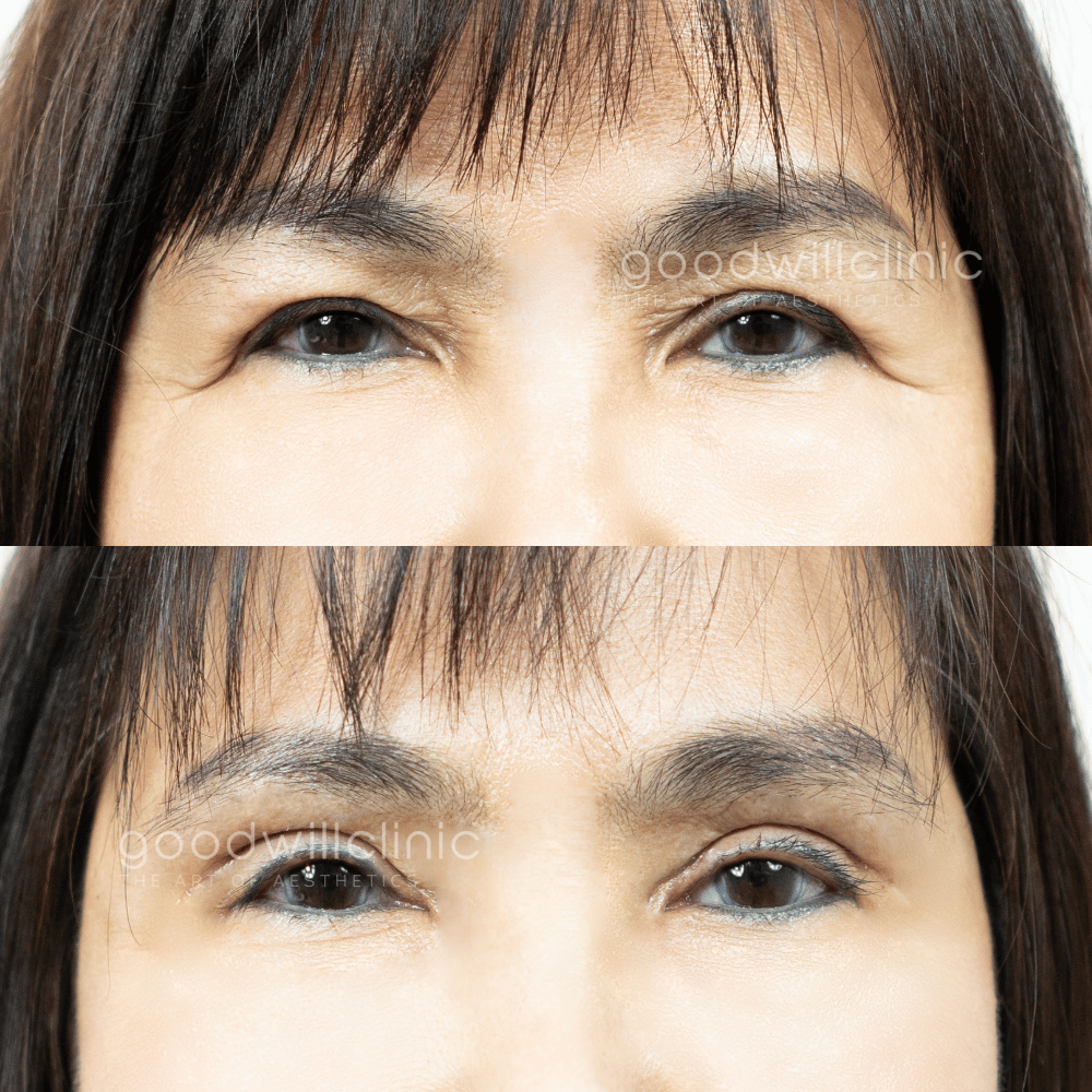 รีวิวไขมันเปลือกตาเยอะ