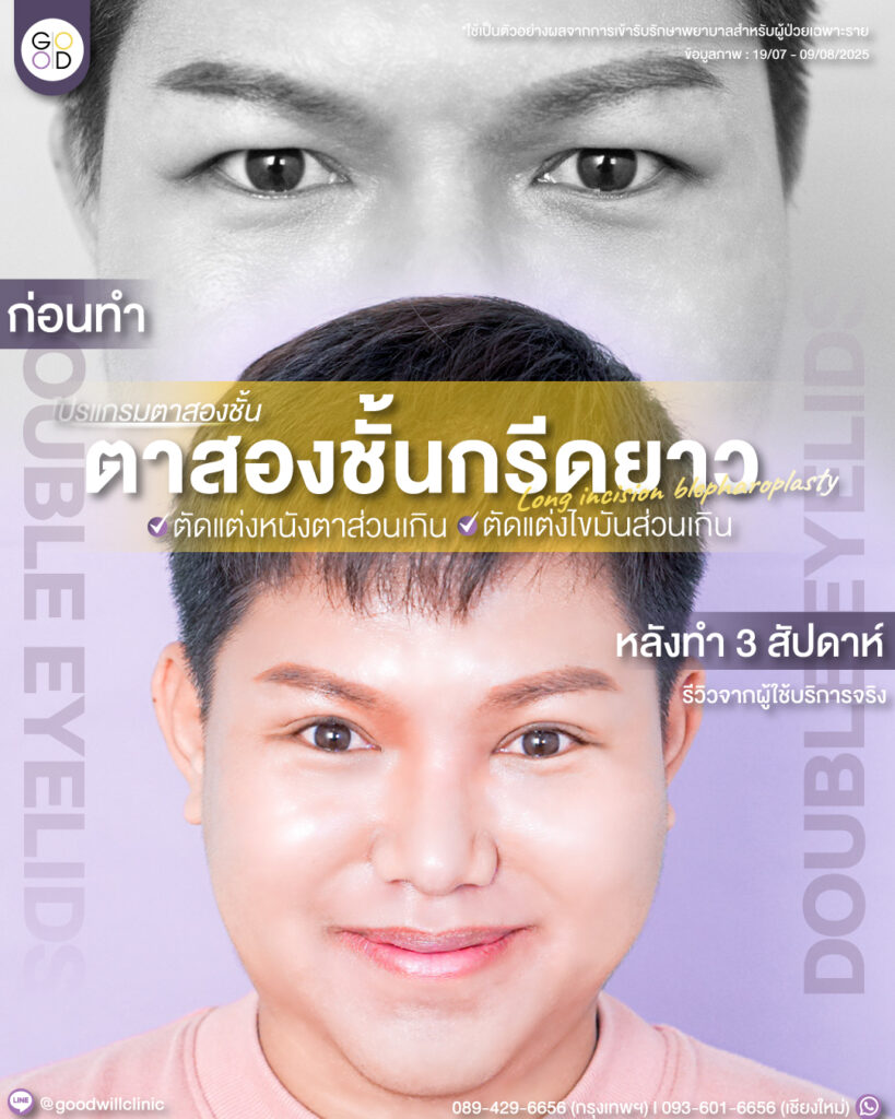 ไขมันตาเยอะผู้ชาย