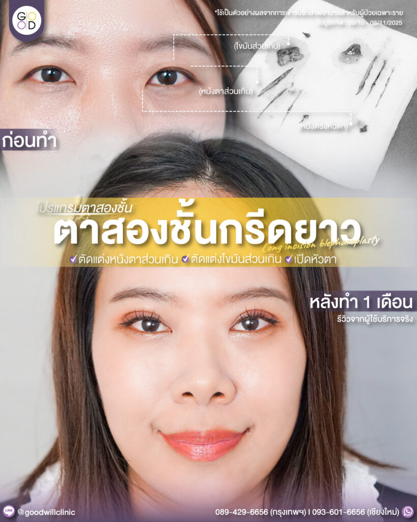 ไขมันตาบนเยอะ3