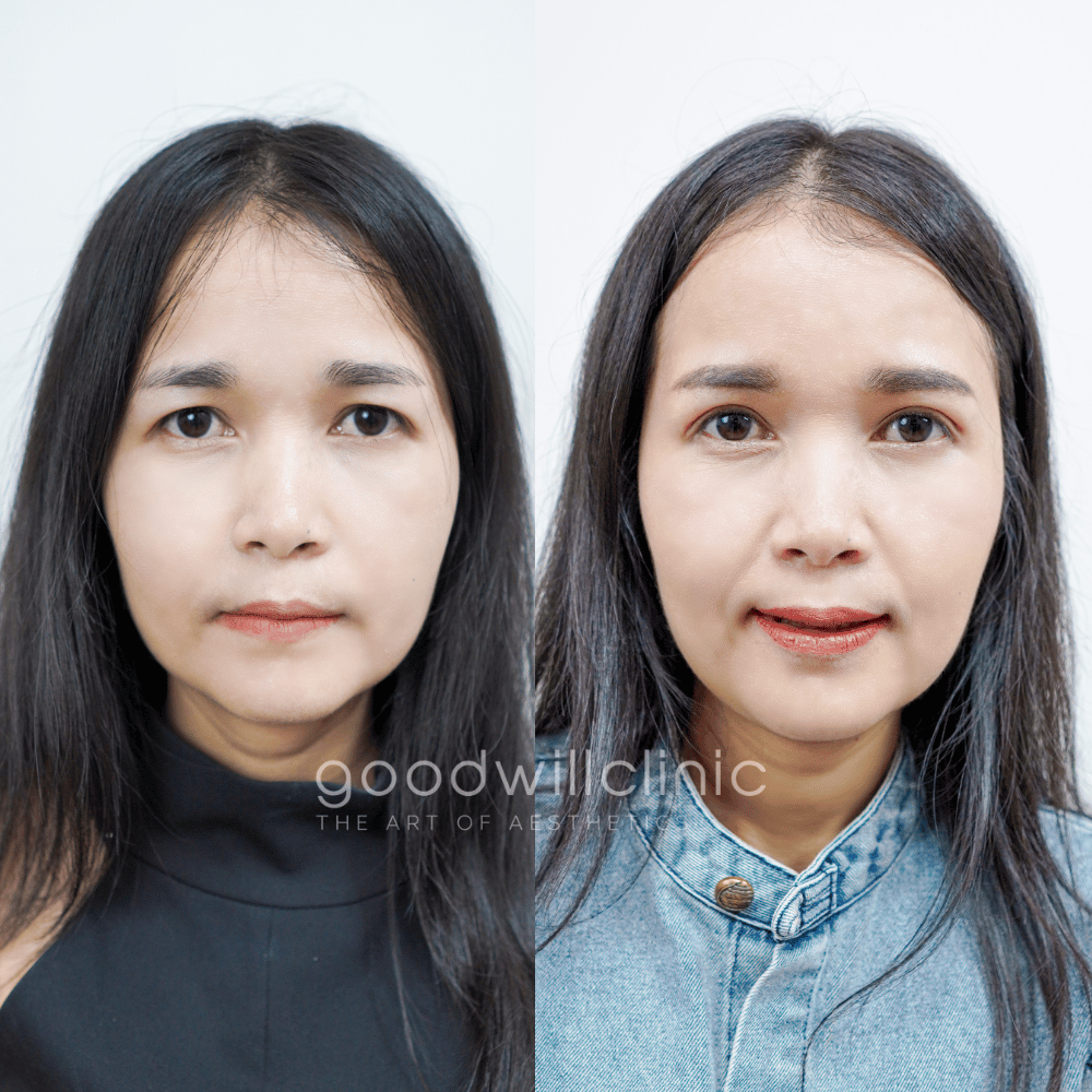 ทำตาสองชั้นปรับบุคลิก2
