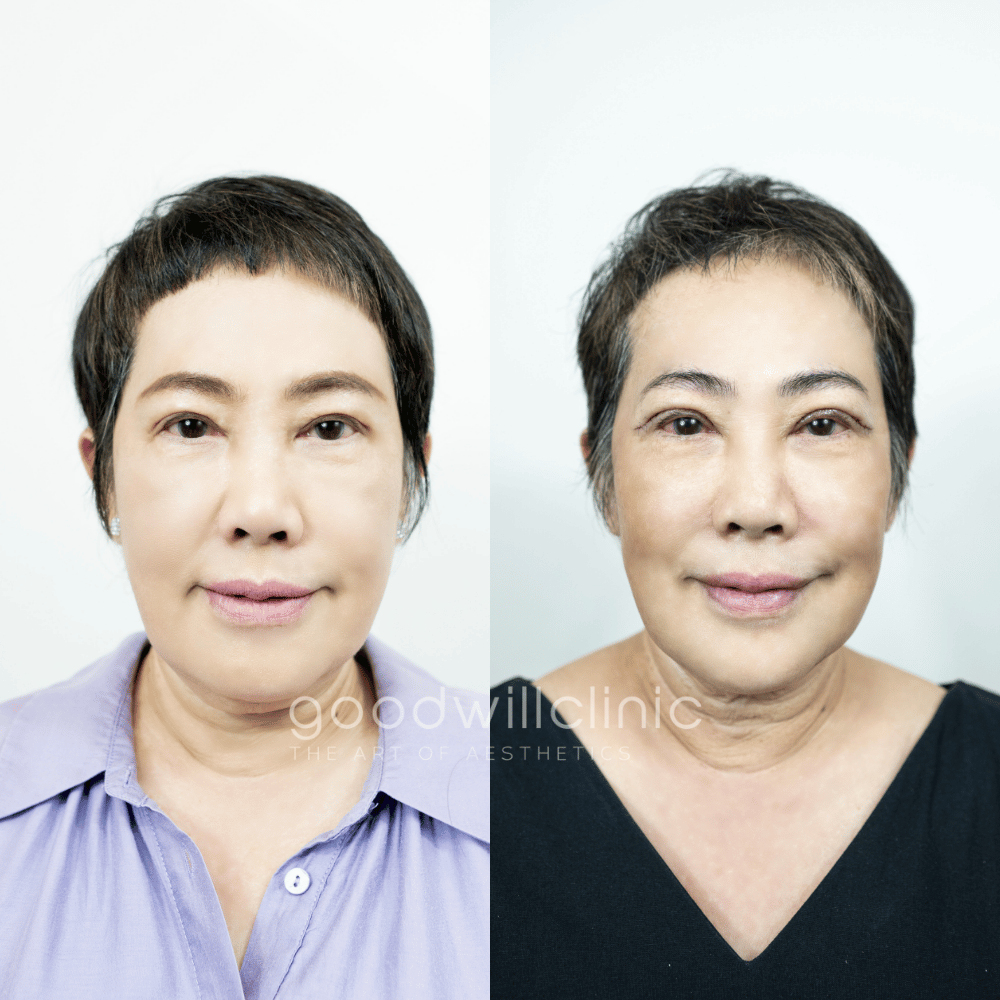 ทำตาสองชั้นปรับบุคลิก4