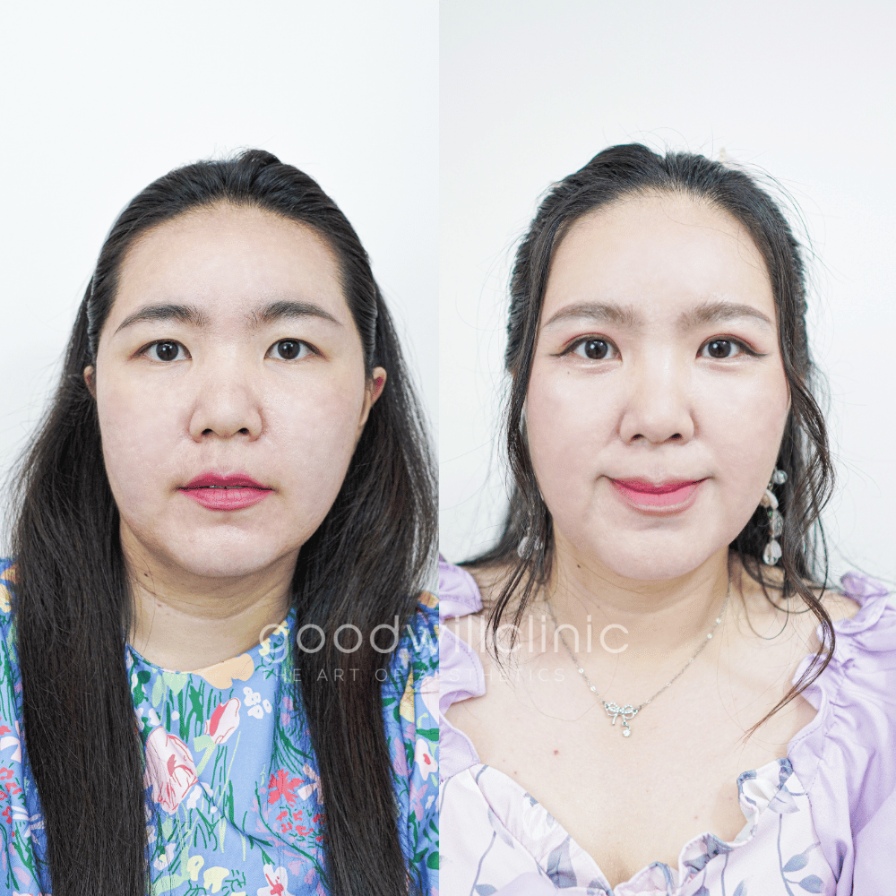 ทำตาสองชั้นปรับบุคลิก8