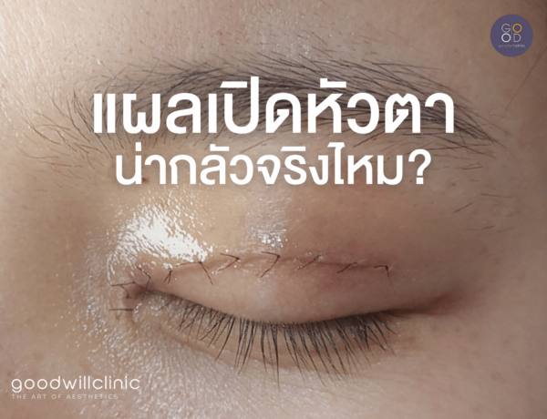แผลเปิดหัวตา น่ากลัวจริงไหม ปก