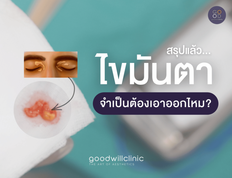 ไขมันตา เอาออกดีไหม ปก