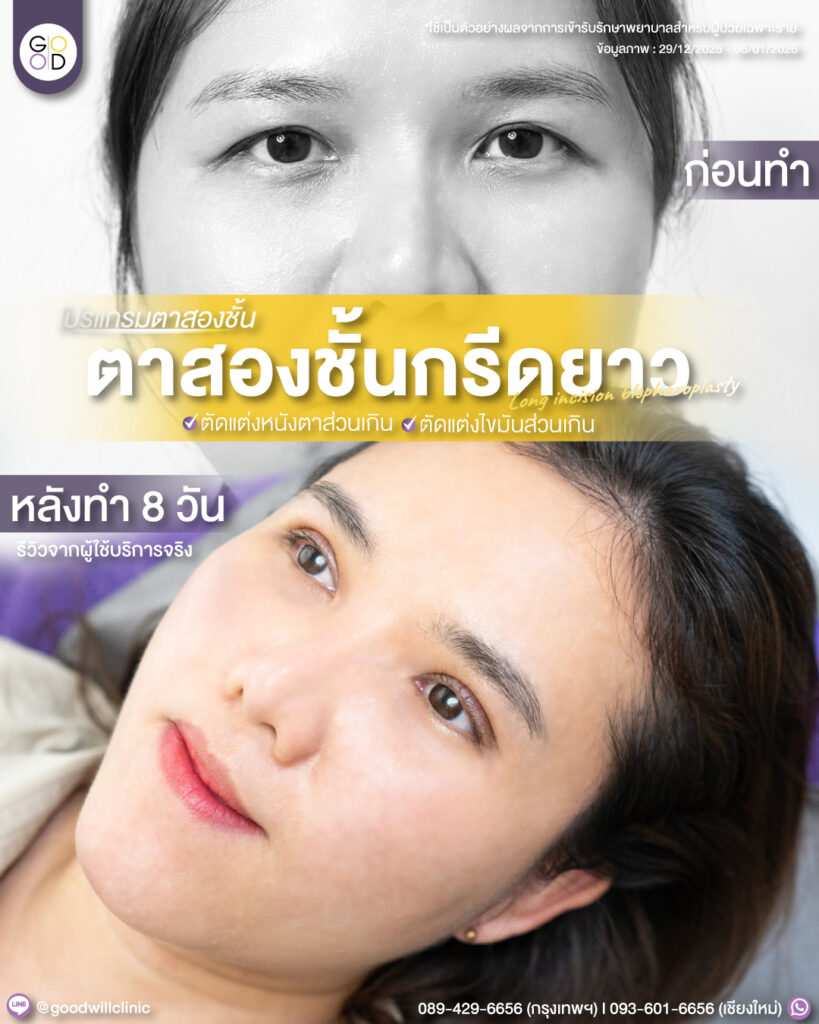 กรีดยาว