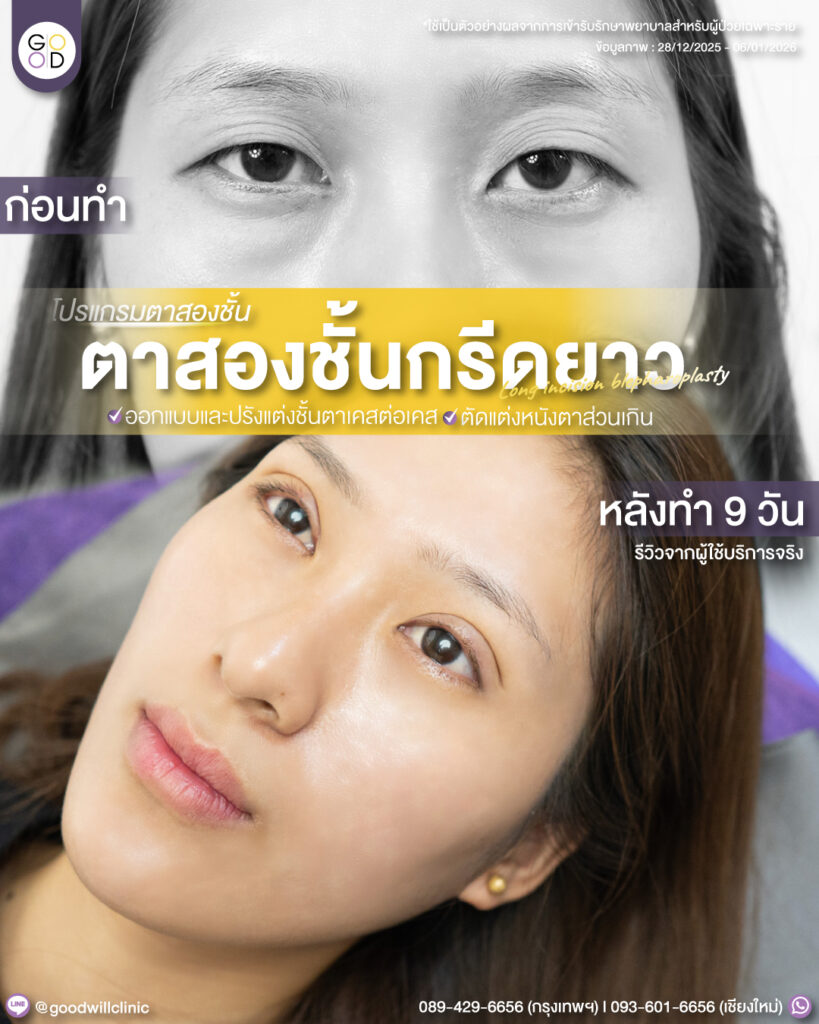 กรีดยาว10