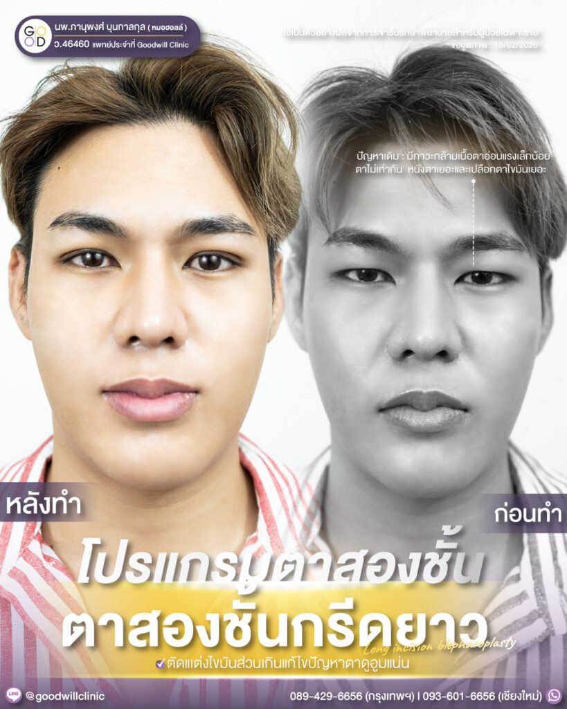 กรีดยาว5