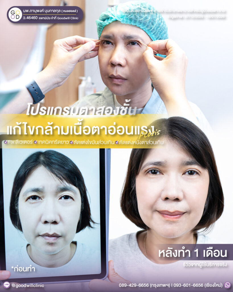 แก้ไขกล้ามเนื้อตา แก้ตาไม่เท่ากัน9