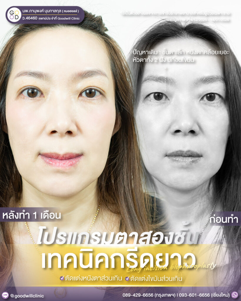 กรีดยาว8