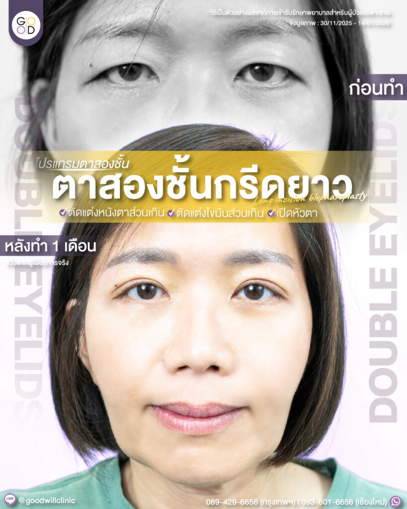 กรีดยาว9