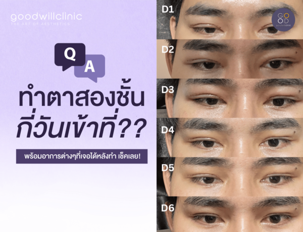 ทำตาสองชั้นกี่วันเข้าที่ cover