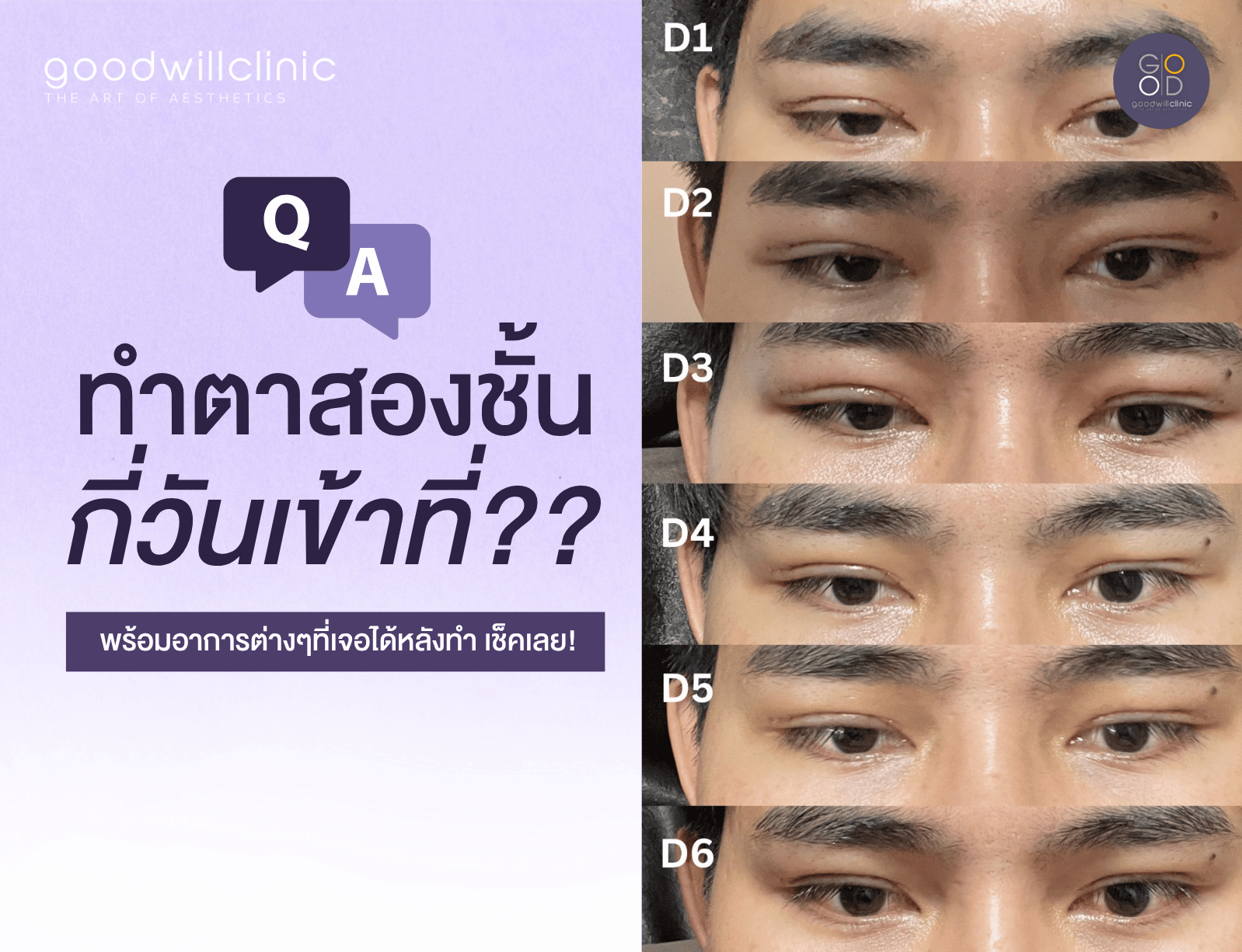 ทำตาสองชั้นกี่วันเข้าที่ cover