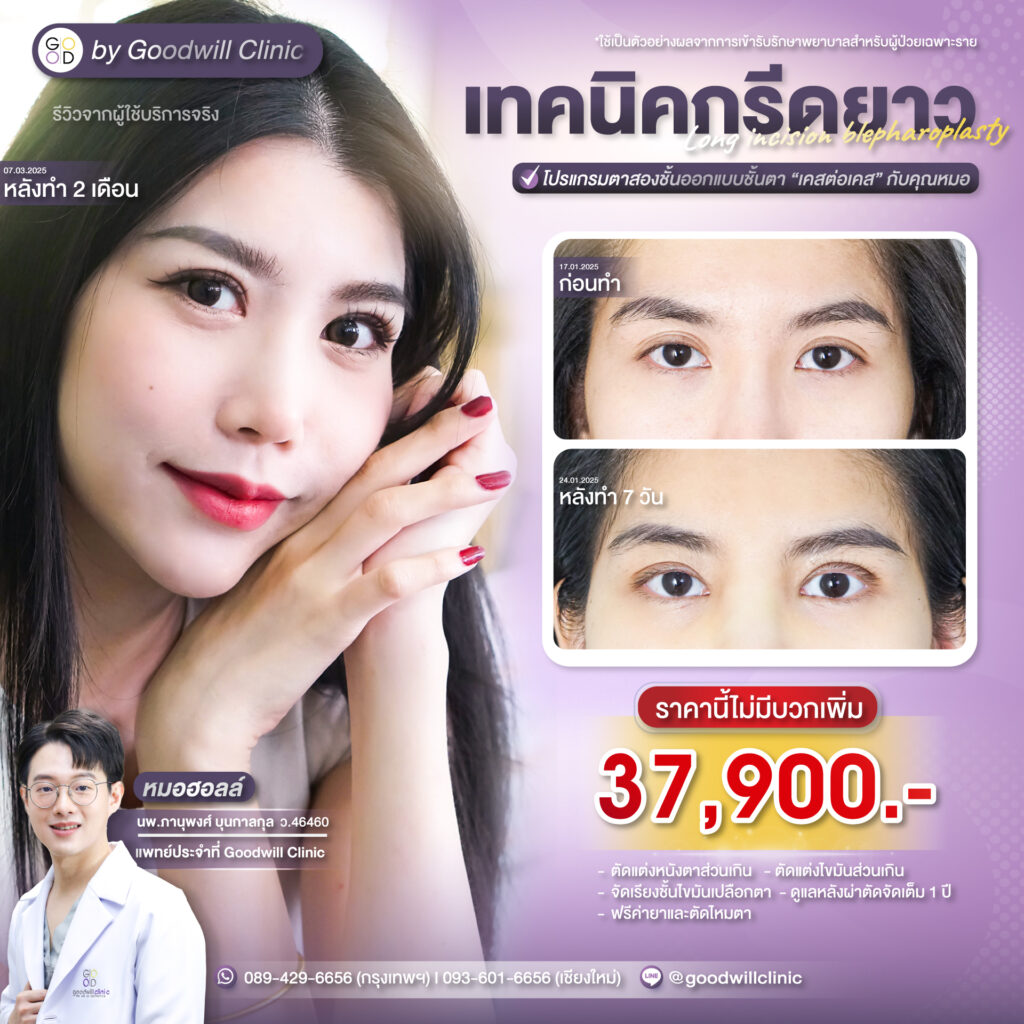 ทำตาสองชั้นราคาเท่าไหร่