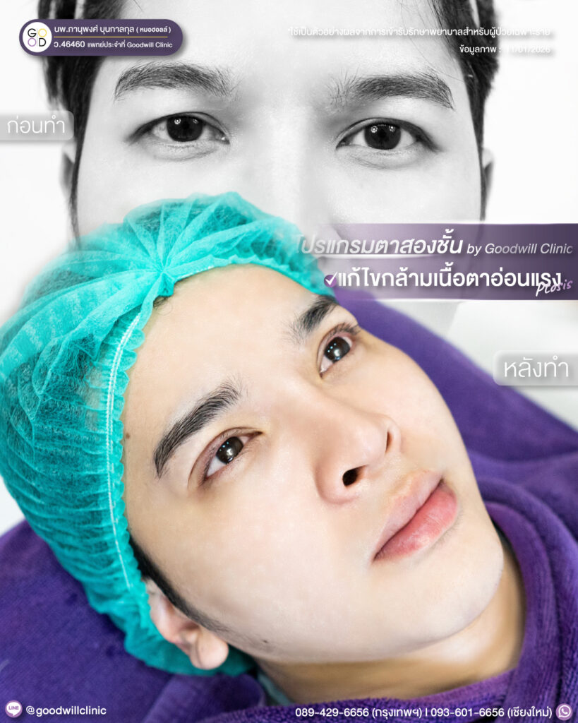 แก้กล้ามเนื้อตา2