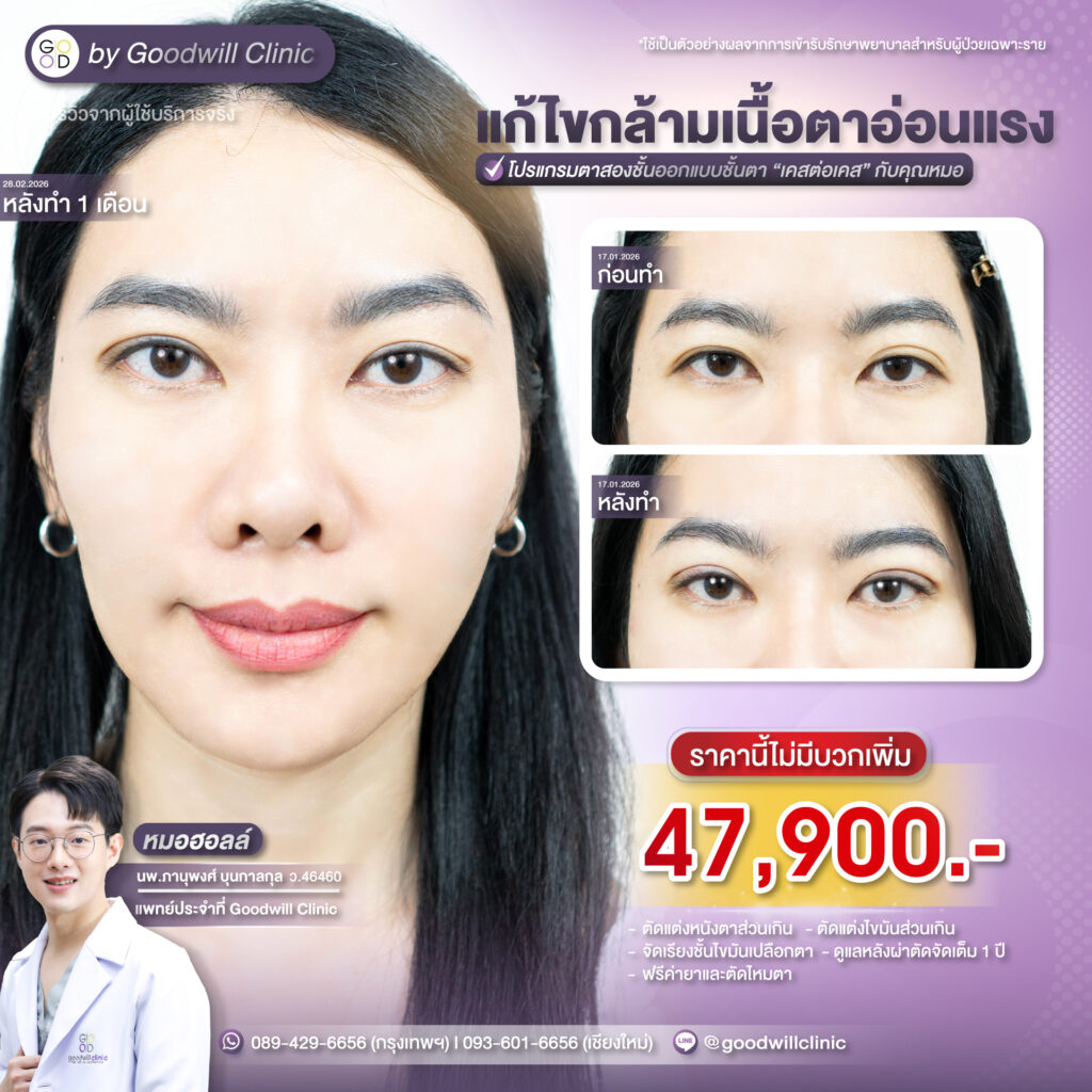 แก้กล้ามเนื้อตาราคาเท่าไหร่