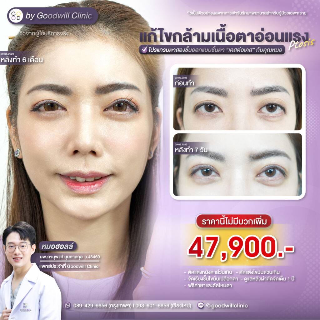 แก้กล้ามเนื้อตาราคาเท่าไหร่1