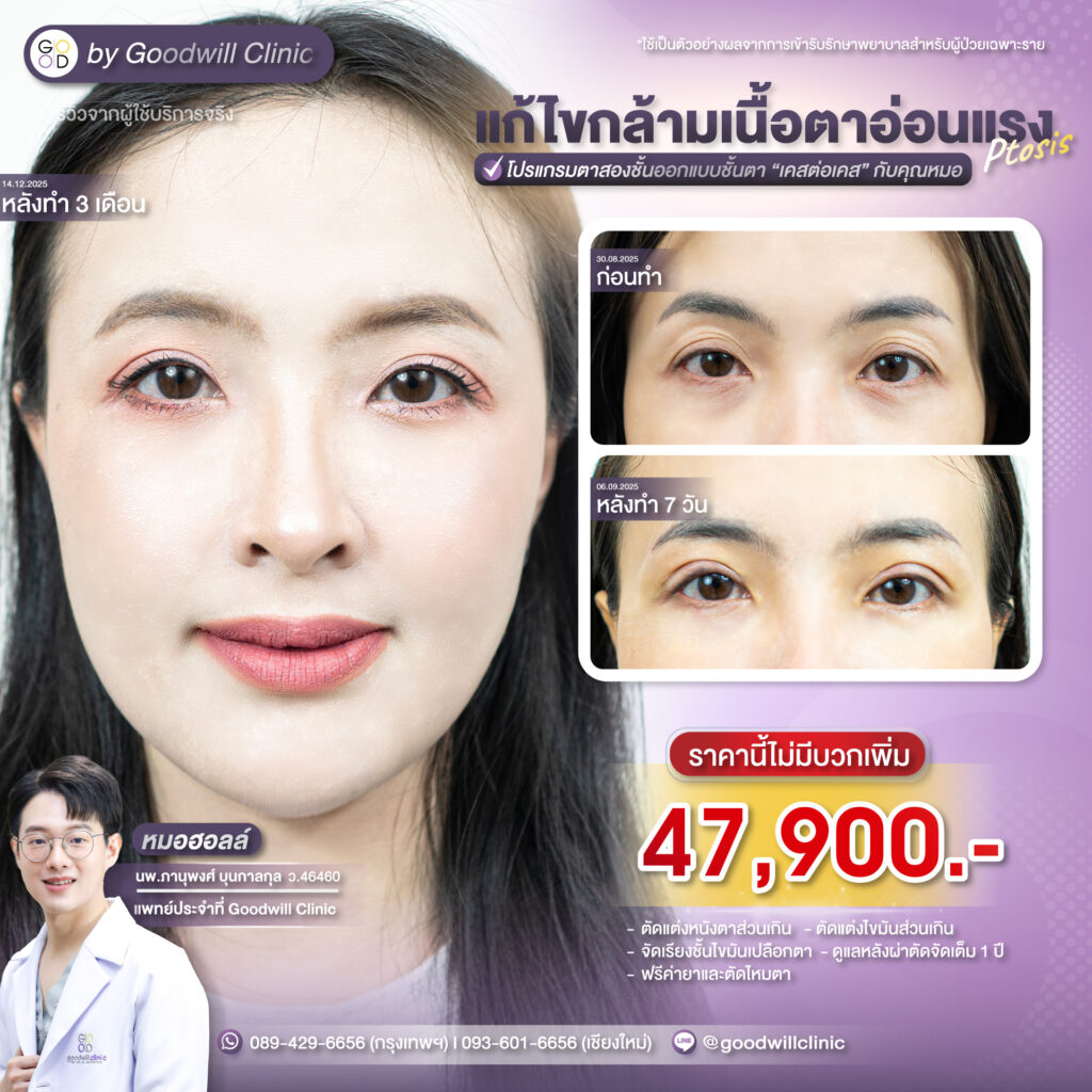 แก้กล้ามเนื้อตาราคาเท่าไหร่3