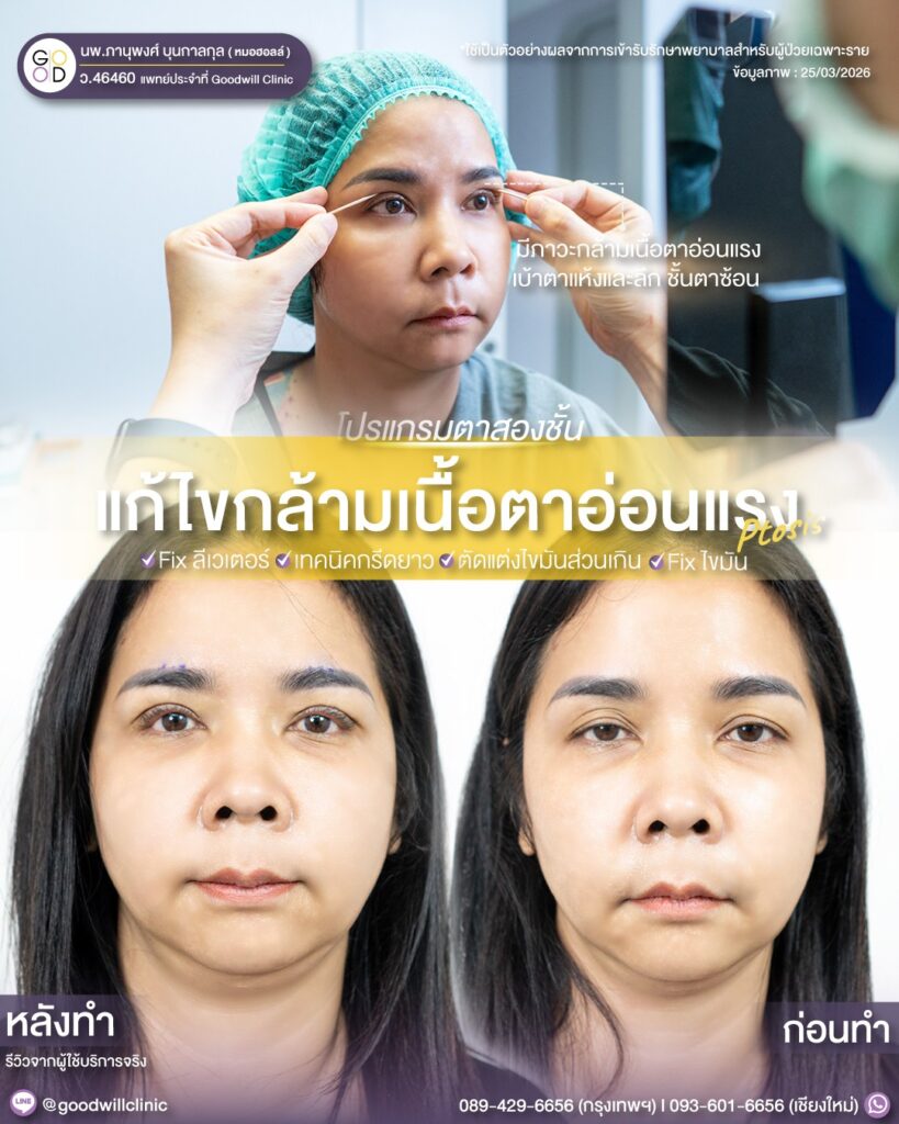 แก้ไขกล้ามเนื้อตา แก้ตาไม่เท่ากัน